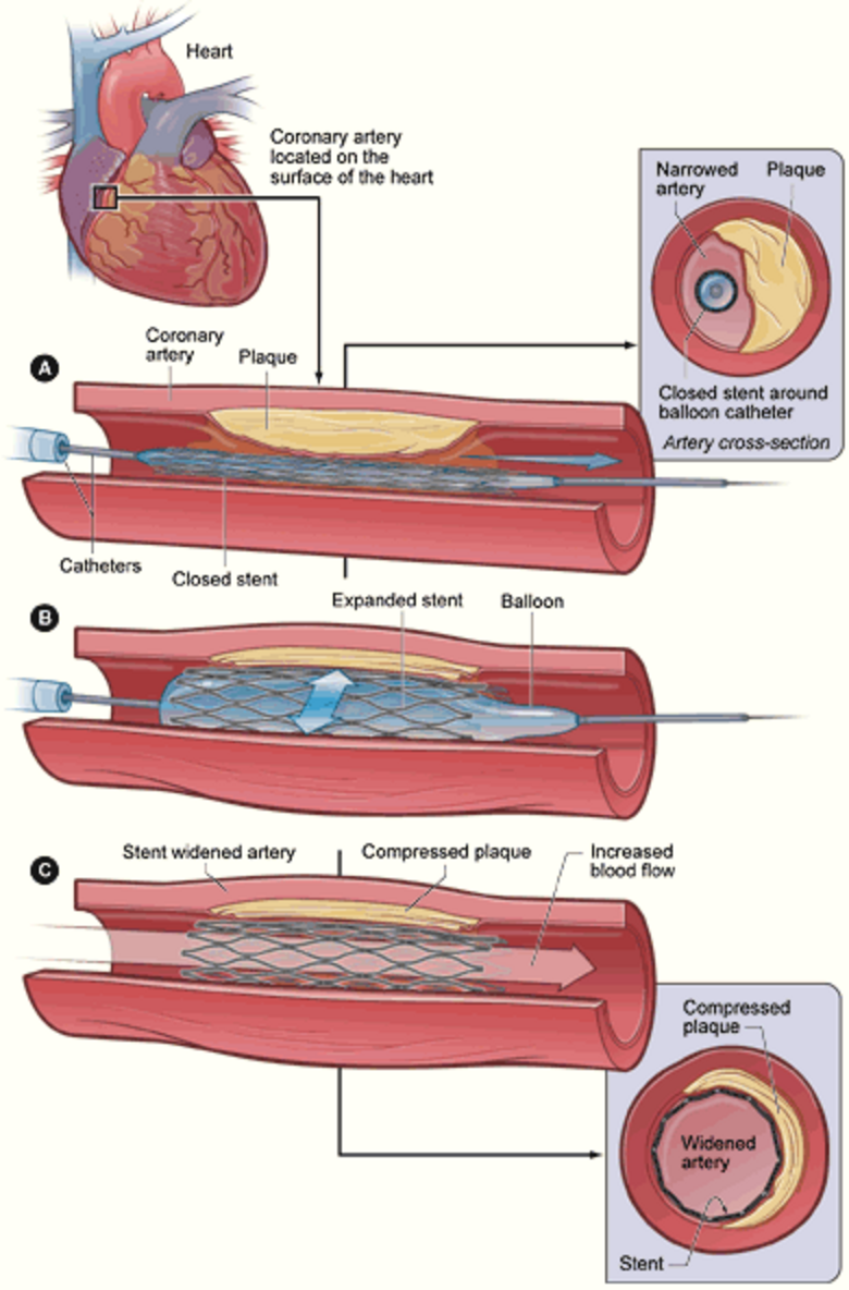 Stent o palloncino coronarico? La differenza spiegata semplice