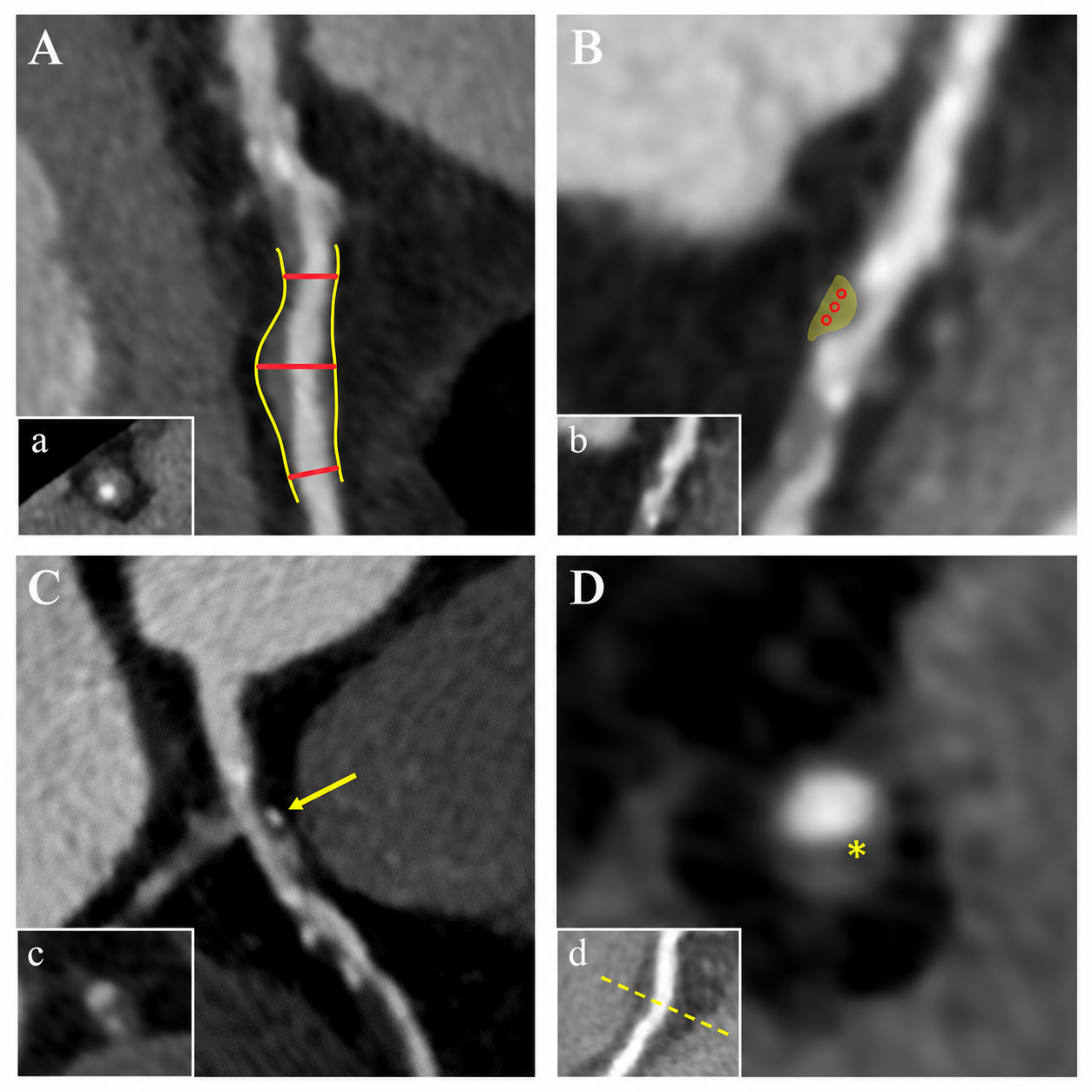 Prediabete, diabete e placche coronariche: cosa ci mostra l’imaging